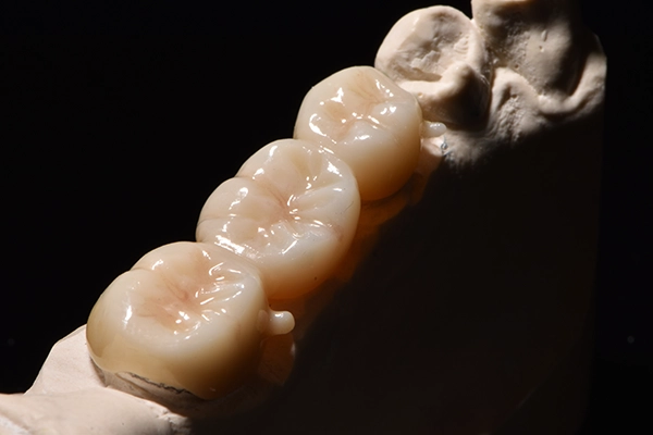 オールセラミッククラウン