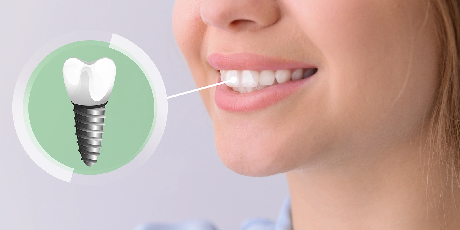 自分の歯のように噛めるインプラント治療