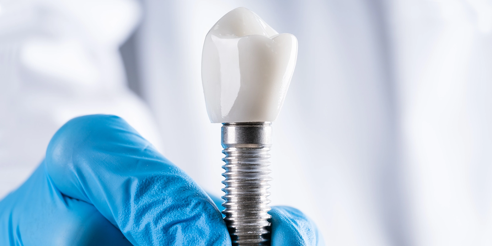 インプラントとはどんな治療？