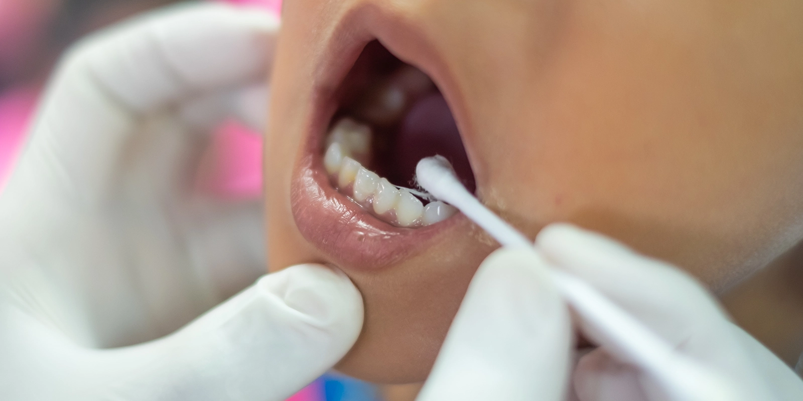 当院の虫歯予防プログラム