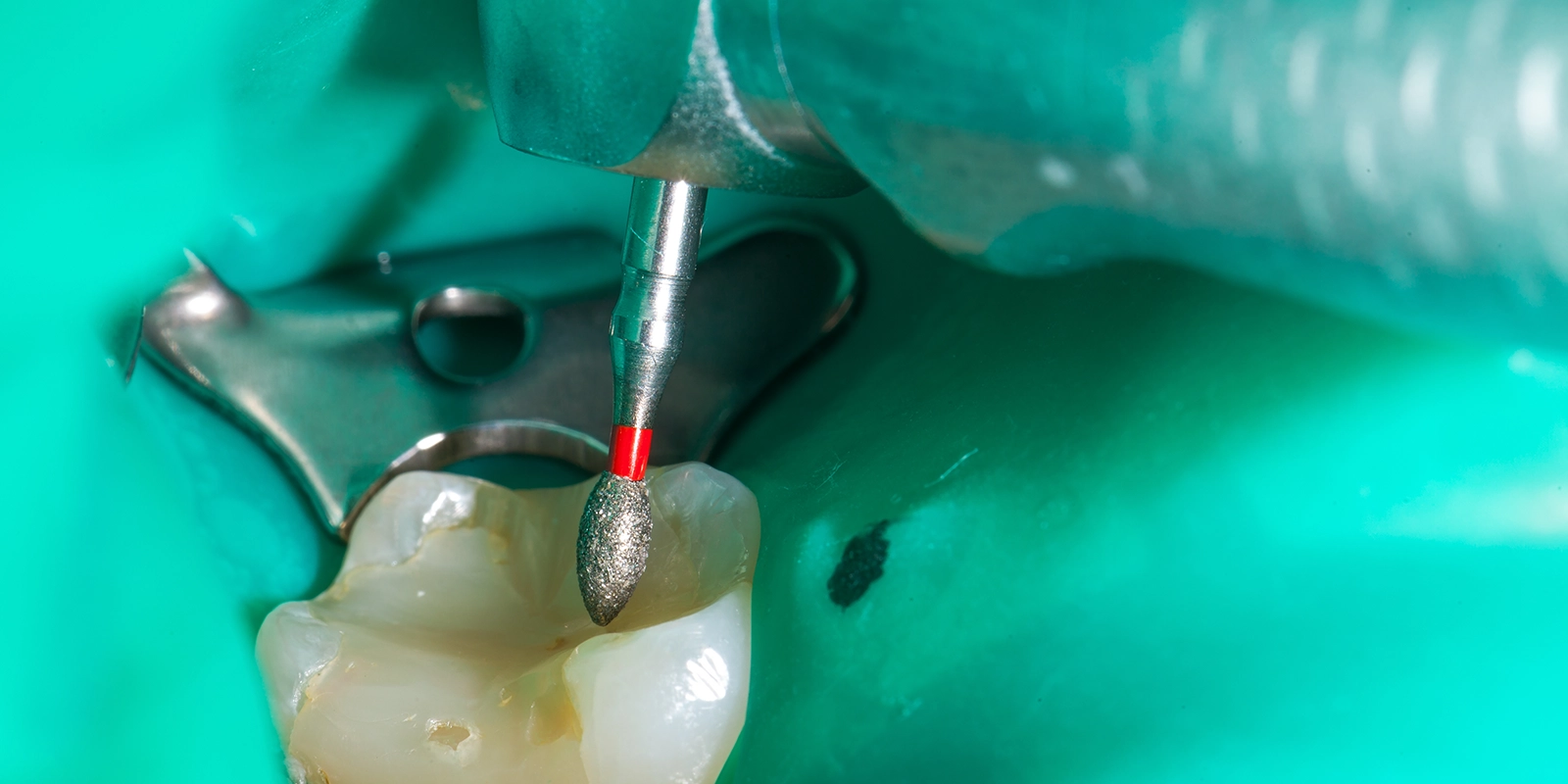 根管治療の流れ