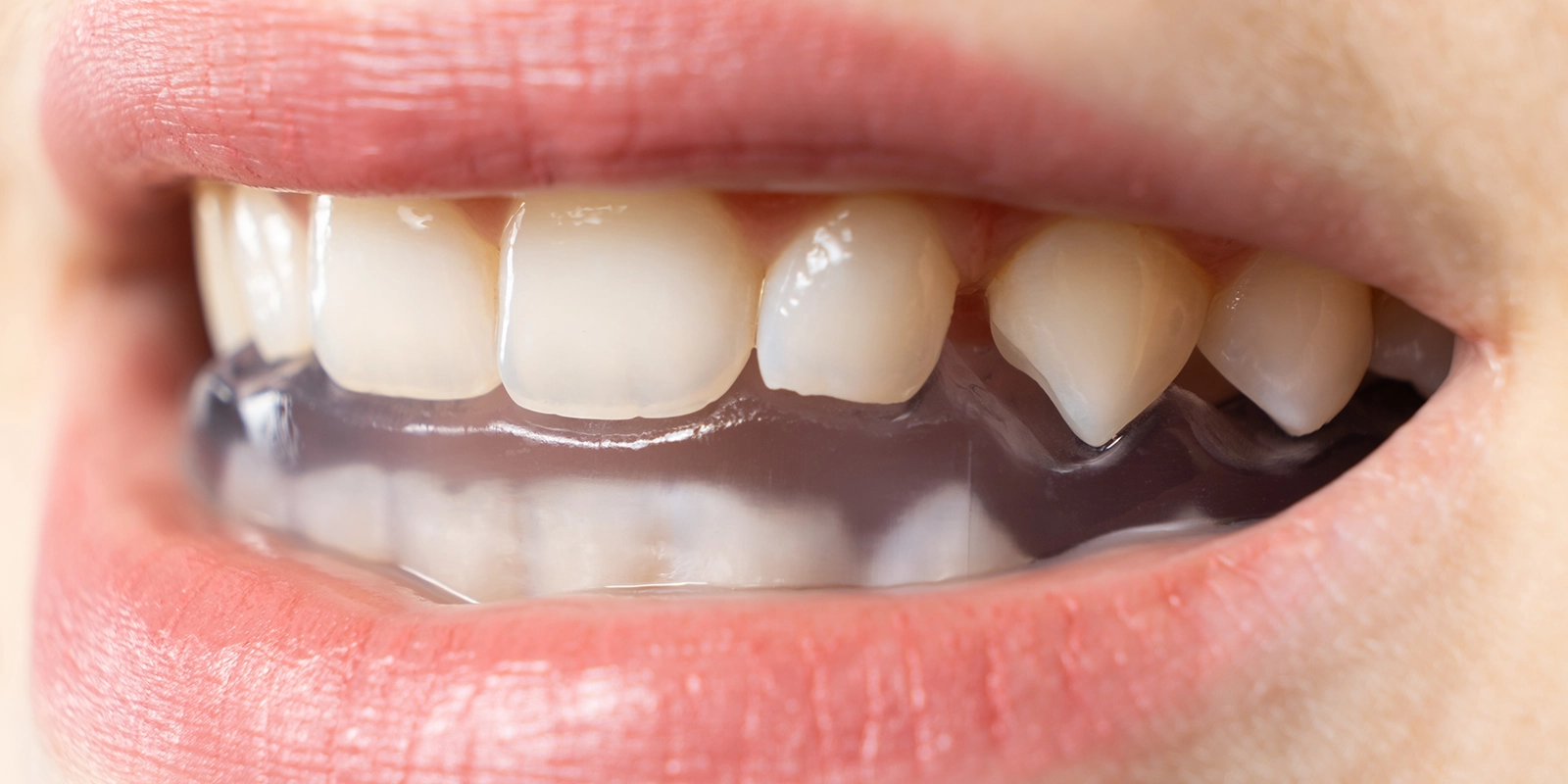 スポーツ歯科の2つの大切な役割