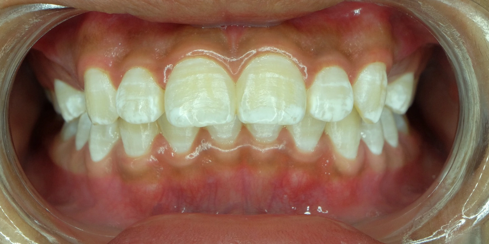 歯を削らずに白いシミを改善