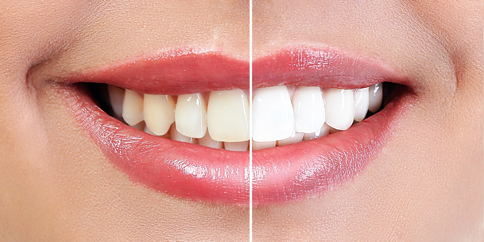 デュアルホワイトニング